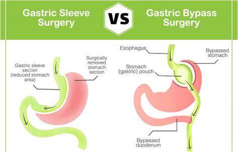 gastric bypass vs sleeve.